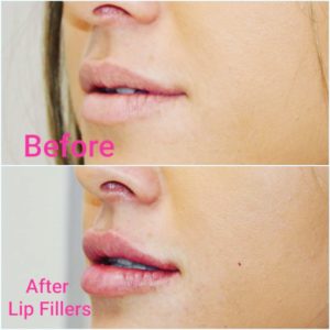 Lip Fillers before and after results Birmingham